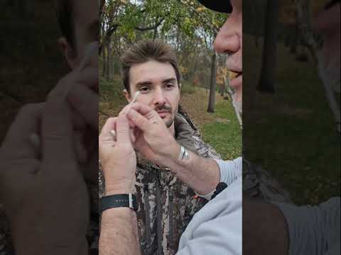 How to Flip an Eyelid to find a foreign body.  #eyeinjury #foreignbodyeye #outdooreyecare #lidflip