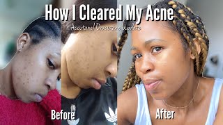 My Skin Care Journey| Accutane/Oracutane Update | 7 month Dermatologist Visit || Products & Prices