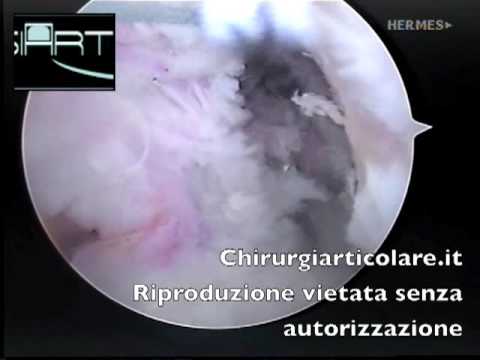 Come sviluppare la frattura del gomito del braccio con la frammentazione Mal di muscoli intorno alla spina dorsale lombare