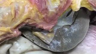 Post-embalmed AUTOPSY