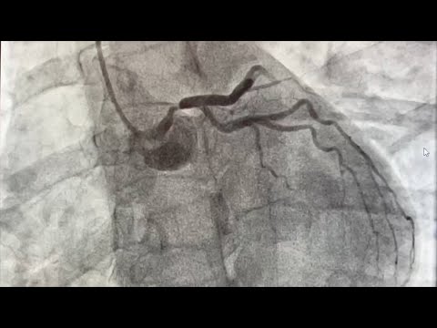 Angiography of the Left Main Coronary Artery