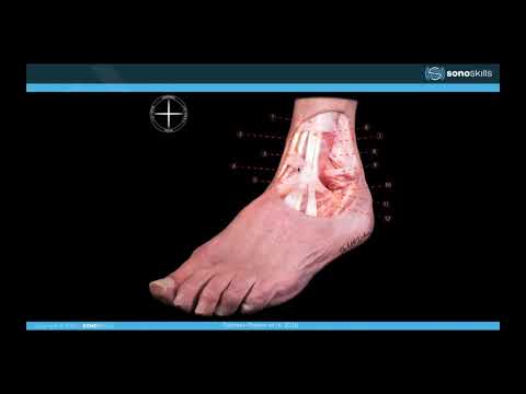 Sonopathology of the Ankle Tendons and Ligaments