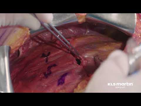 Subscapular Rib Fracture Treatment Technique using the L1 Rib System