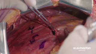 Subscapular Rib Fracture Treatment Technique using the L1 Rib System