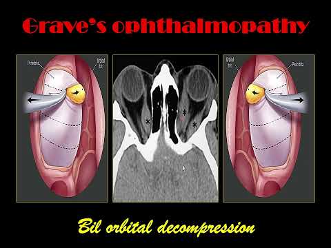 CT scan, nose and paranasal sinus (4); Preoperative FESS checklist, lamina papyracea surgery