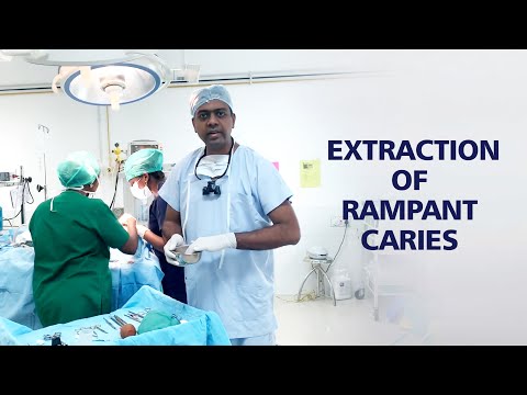 Rampant Caries Made Us Extract 12 Teeth And Restore The Remaining In This 5 Year Old