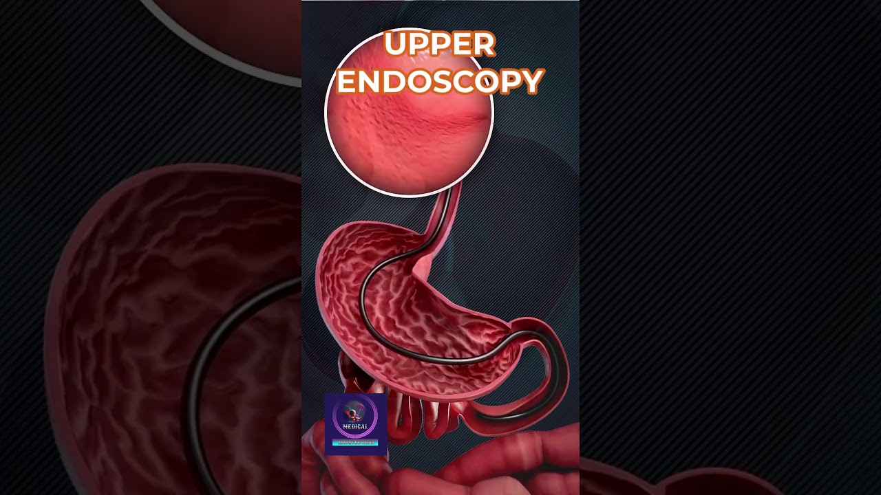 Upper Endoscopy EGD – How to Prepare for an Upper Endoscopy Test