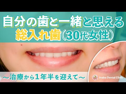 自分の歯と一緒と思える総入れ歯(30代女性)〜治療から1年半を迎えて〜