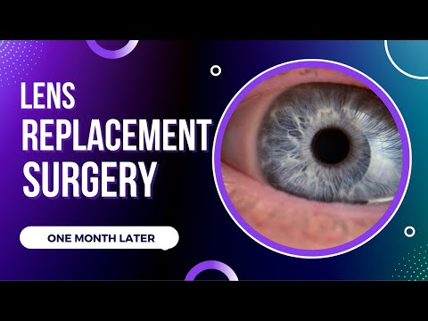 Lens Replacement Surgery one month later - an honest review