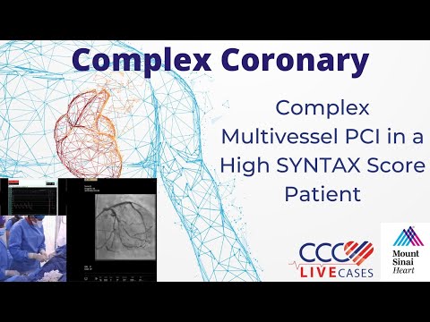 Complex Multivessel PCI in a High SYNTAX Score Patient