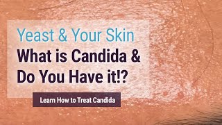 Yeast affecting your skin? You may have it and not know! (Candida Albicans)