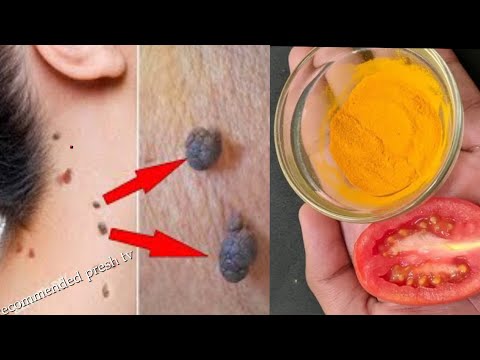 , title : 'REMOVE SKIN TAG IN 1 NIGHT OF APPLYING TOMATO Home Remedies To Remove Skin Tags Easily'
