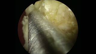 Asvide: Large stone in neobladder: percutaneous neocystolithotomy.