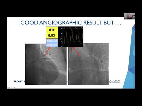 Left Main and Bifurcation Lesions - Road to Success Percutaneous Coronary Intervention
