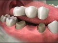 Tooth Bridge 3 Unit Bridge Roseville Dentist