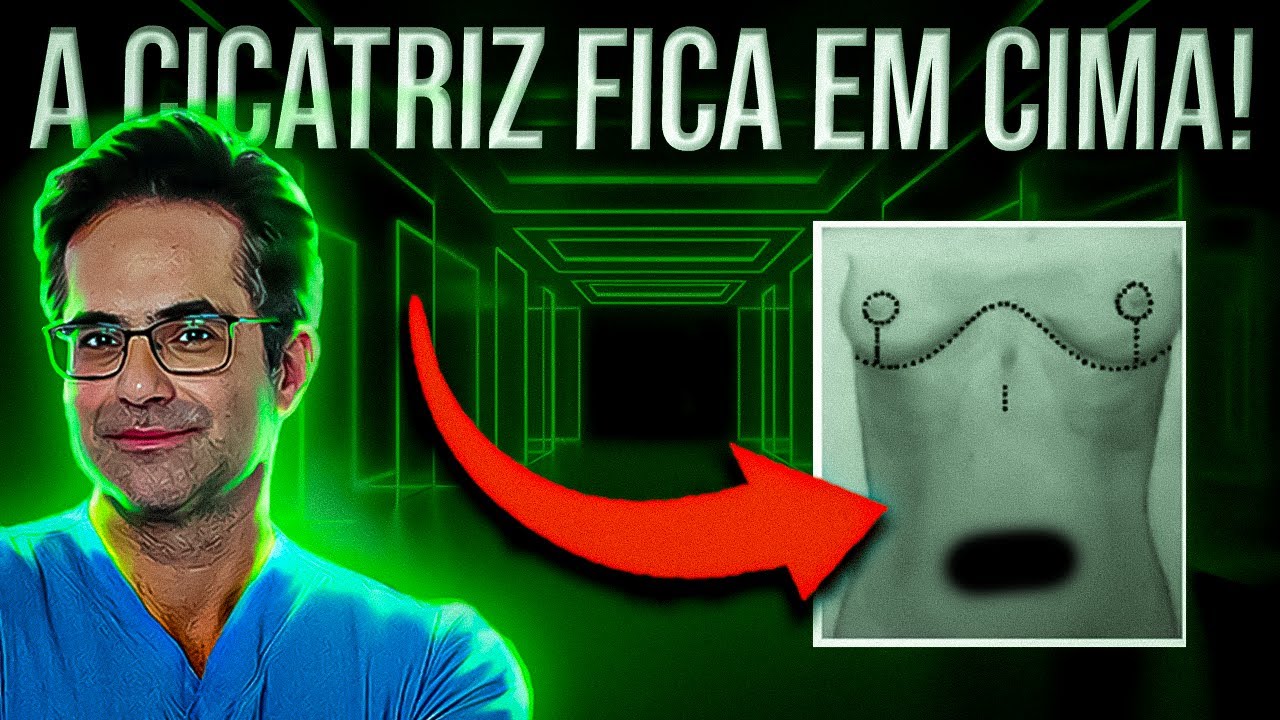 Tudo sobre ABDOMINOPLASTIA REVERSA