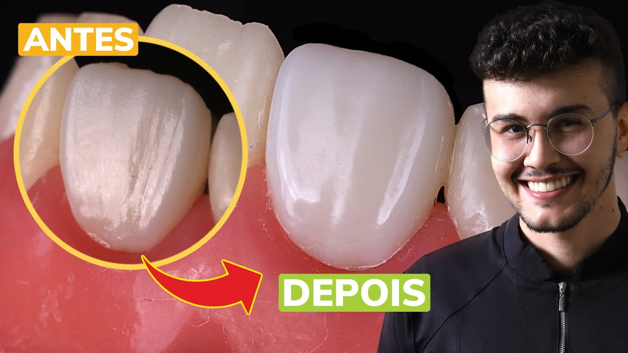 Polimento Facetas em Resina Composta [TUTORIAL] Melhor kit (Passo a passo)