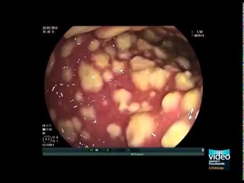 c diff fogyást okoz zsírégetéshez oxigén szükséges