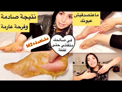 بملعقة قرنفل ونصف كوب من الخل ودعي وللأبد إسمرار وتجاعيد ليدين ورجلين وتشققات من أول يوم لازم ????لكل هنا hana