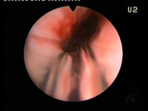 Wie unter castoreum Tinktur Prostatitis Wachstum von Prostata-Adenom nach der Operation