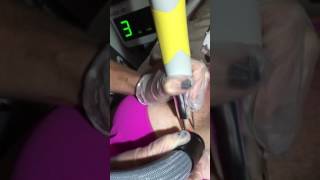 Breast Cancer  Radiation Tattoo Removal