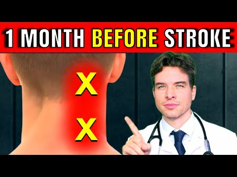 3 Early Warning Signs of a Stroke - Recognize Stroke Symptoms FAST: THIS Could Save Your Life