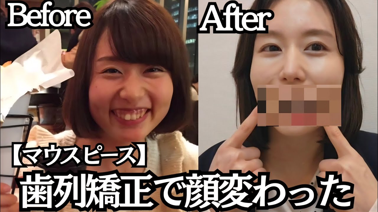 【整形級】マウスピース矯正で大きな変化