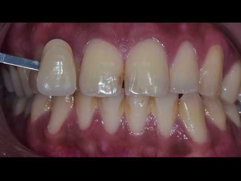 image-What shade is the most common tooth color?
