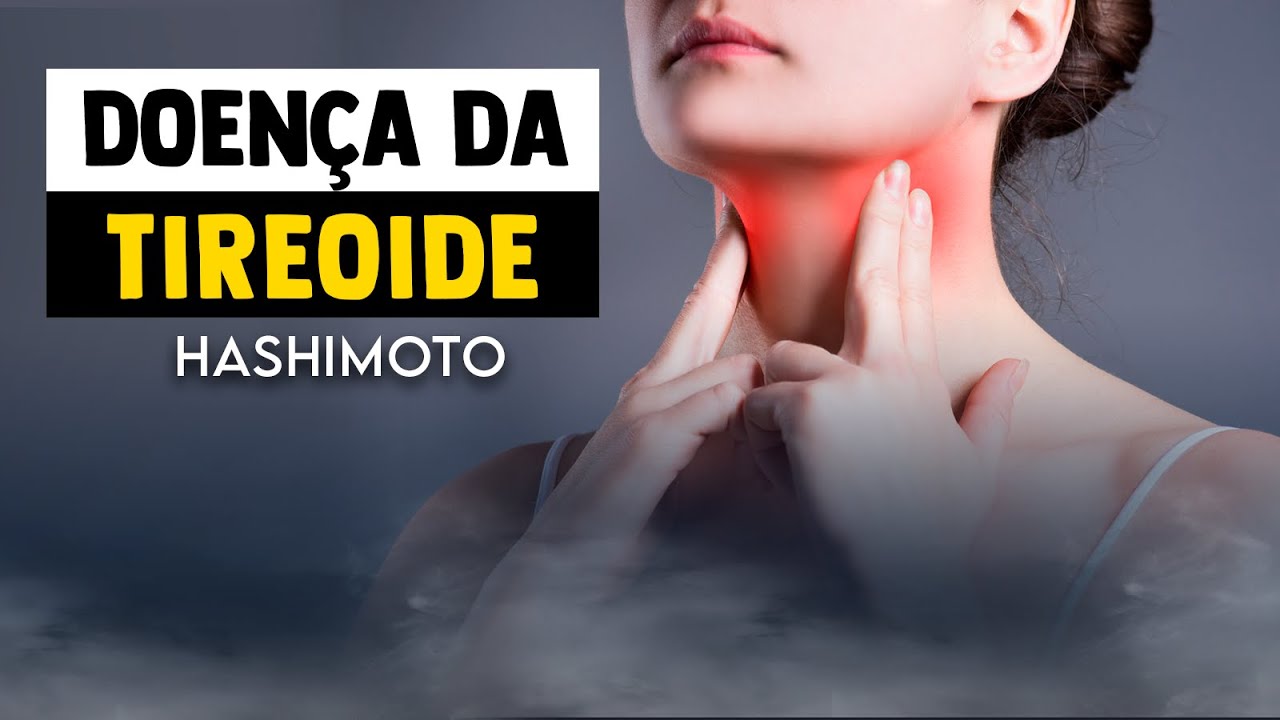 DOENÇA DA TIREOIDE: Como ela afeta o corpo e o seu pescoço? │ Tireoidite de Hashimoto