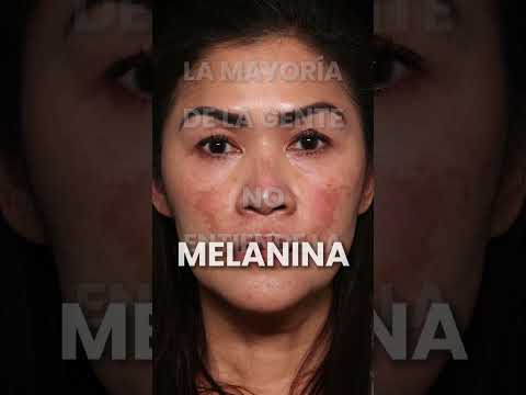 TRATAMIENTOS PARA PACIENTES CON PIEL RICA EN MELANINA Y MELASMA