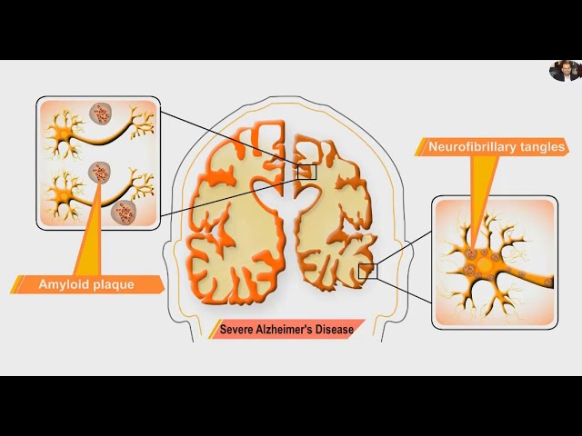 Wymowa wideo od amyloid na Angielski