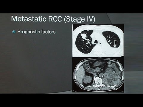 Cancer of renal
