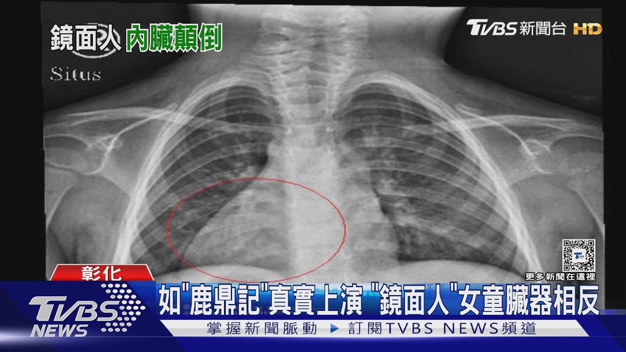 如「鹿鼎記」真實上演 「鏡面人」女童臟器相反