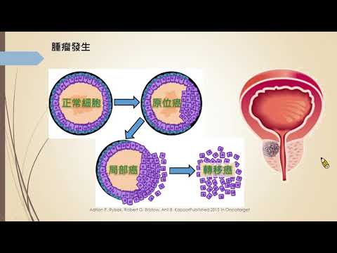 攝護腺癌的電光放射治療(趙勇全醫師)