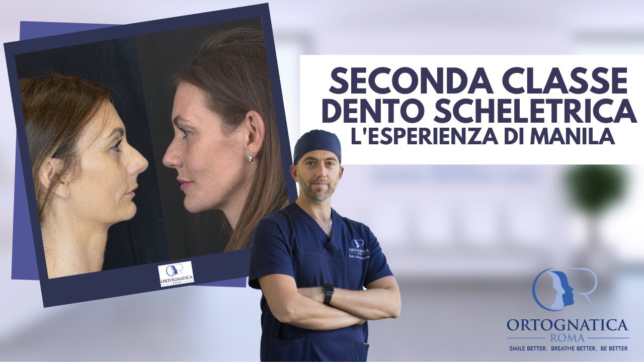 Seconda Classe Dento Scheletrica: l'esperienza di Manila con la chirurgia ortognatica