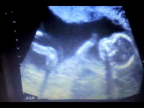 Ultraljud vecka 19 - Bebis suger på tummen :)