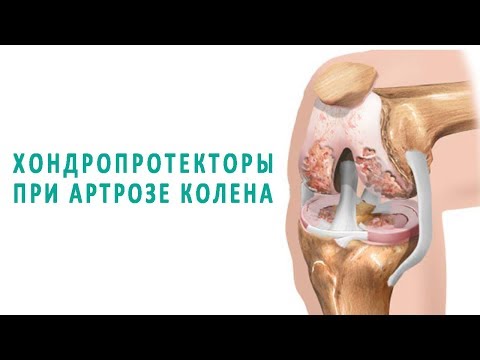 Необычные способы лечения суставов Заболели коленные суставы