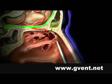 Sinus Treatment In India | Sinusitis Cure Kerala | Modified Lothrop Procedure