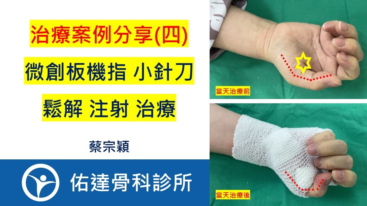 微創板機指 小針刀 鬆解 注射 治療：治療案例分享（四）【佑達骨科】【蔡宗穎醫師】 - AI健康醫療影片