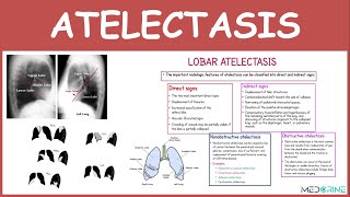Atelectasis Types, Pathophysiology and X-RAY Findings Simplified