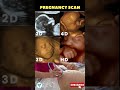 See Your Baby Face In Pregnancy 2D 3D 4D HD Baby Scan Pregnancy Scan Reports Shortsvideo