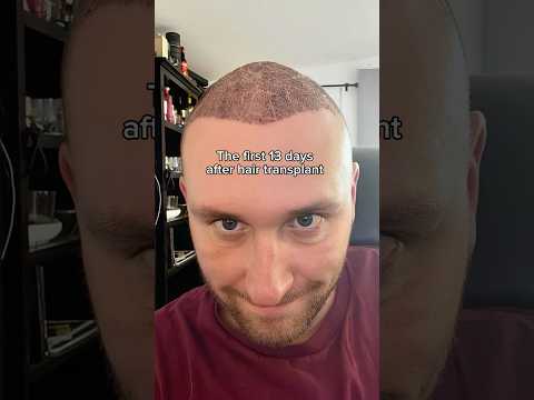 Hair Transplant Journey: 13 Days of SHOCKING Changes!