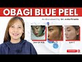 OBAGI BLUE PEEL TREATMENT