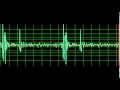 Normal Heart Sound Slow