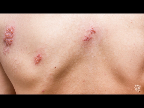 Mayo Clinic Minute: Don't suffer with shingles