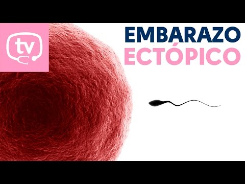 ¿Qué es un embarazo ectópico?