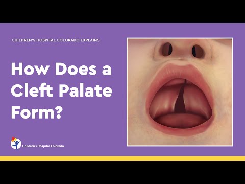 How Does a Cleft Palate Form?