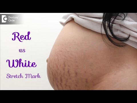 Dark stretch marks & Light stretch marks. Causes & Treatment - Dr. Rasya Dixit | Doctors' Circle