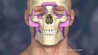 Mayo Clinic’s First Face Transplant: The Surgery