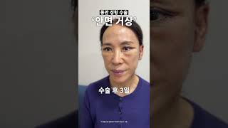안면거상술 성형 시술